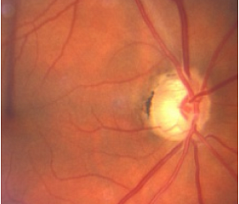 Глаукома – причины, симптомы, диагностика и лечение 