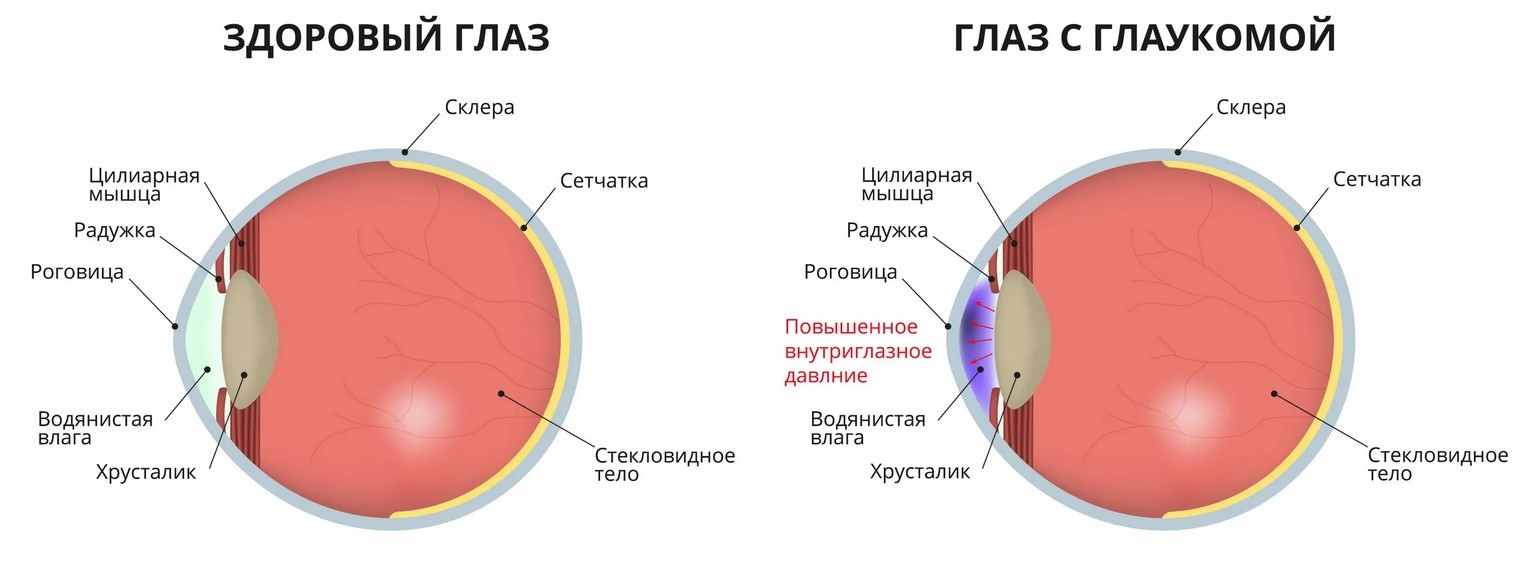 Глаукома – схема