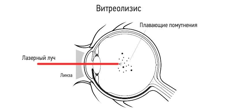 Лечение деструкции стекловидного тела глаза