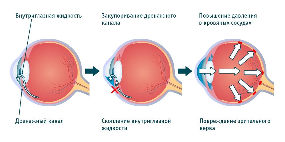 Как снизить внутриглазное давление при глаукоме
