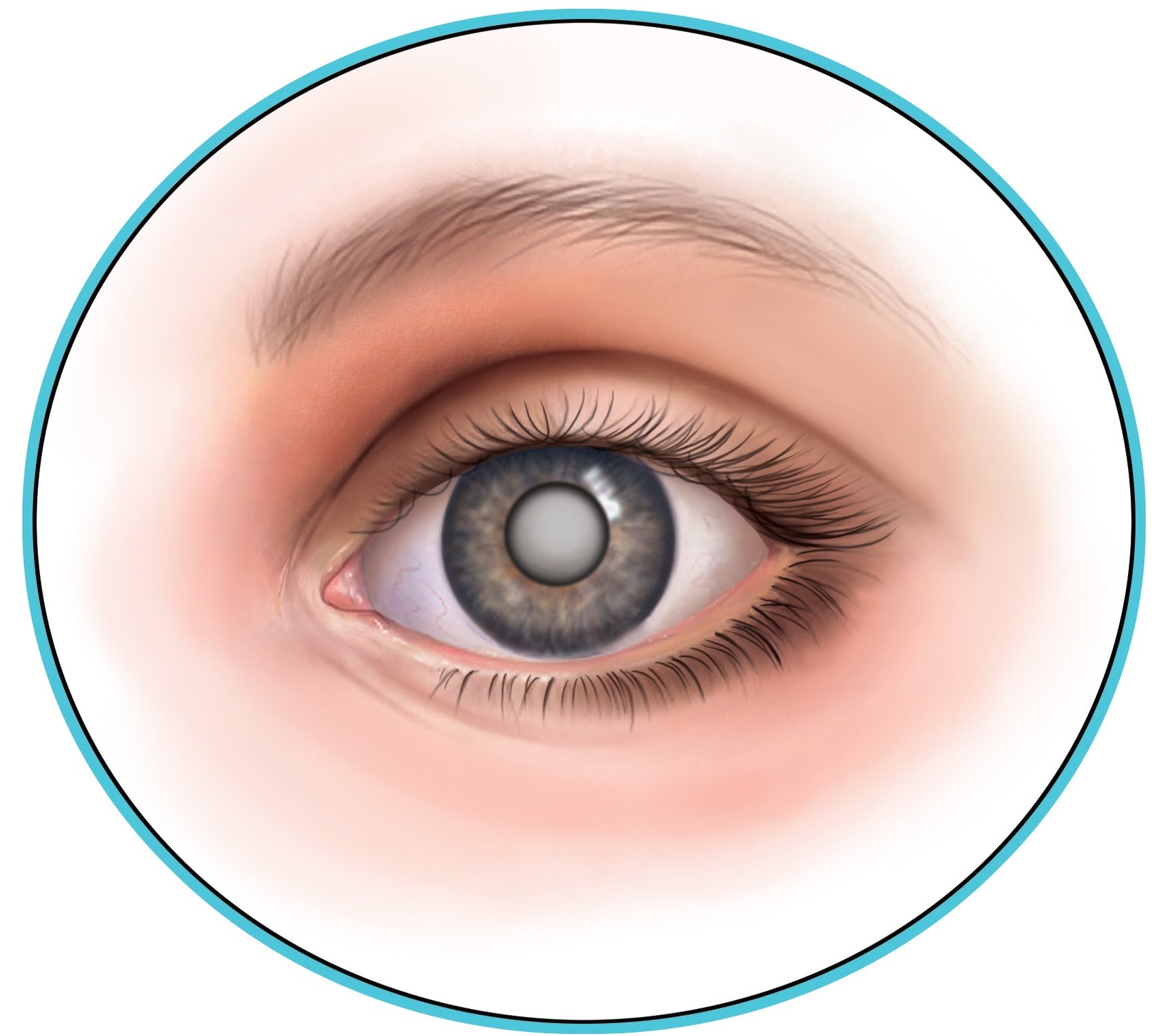 Симптомы, причины и методы лечения катаракты