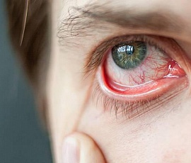 Синдром красного глаза