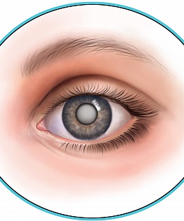 Симптомы, причины и методы лечения катаракты