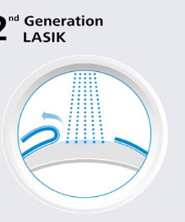 Основные методы лазерной коррекции зрения: LASIK, SMILE, ФРК